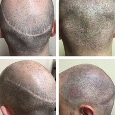 Looking for a scalp micropigmentation clinic in Torbay UK