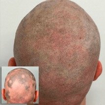 How Facial Secrets in Torquay can help with Scalp Micropigmentation UK