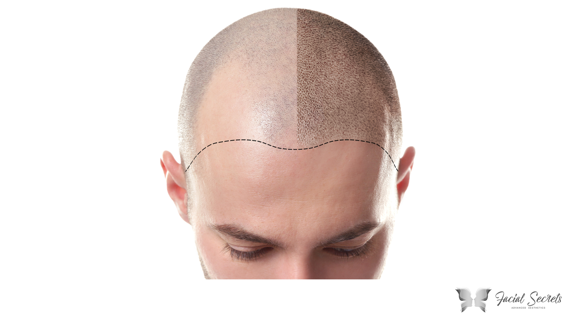 Male and female scalp micropigmentation treatments available Torbay