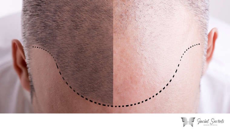 Scalp Micropigmentation